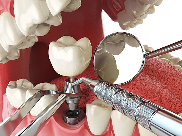Best Knocked-Out Tooth Emergency  in Cambridge, MN